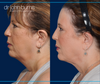 Left Profile VIew | Before and After Neck Lift with Neck LIpo by Dallas Plastic Surgeon, Dr. John Burns