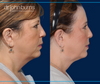 Right Profile View | Before and After Neck Lift with Neck LIpo by Dallas Plastic Surgeon, Dr. John Burns
