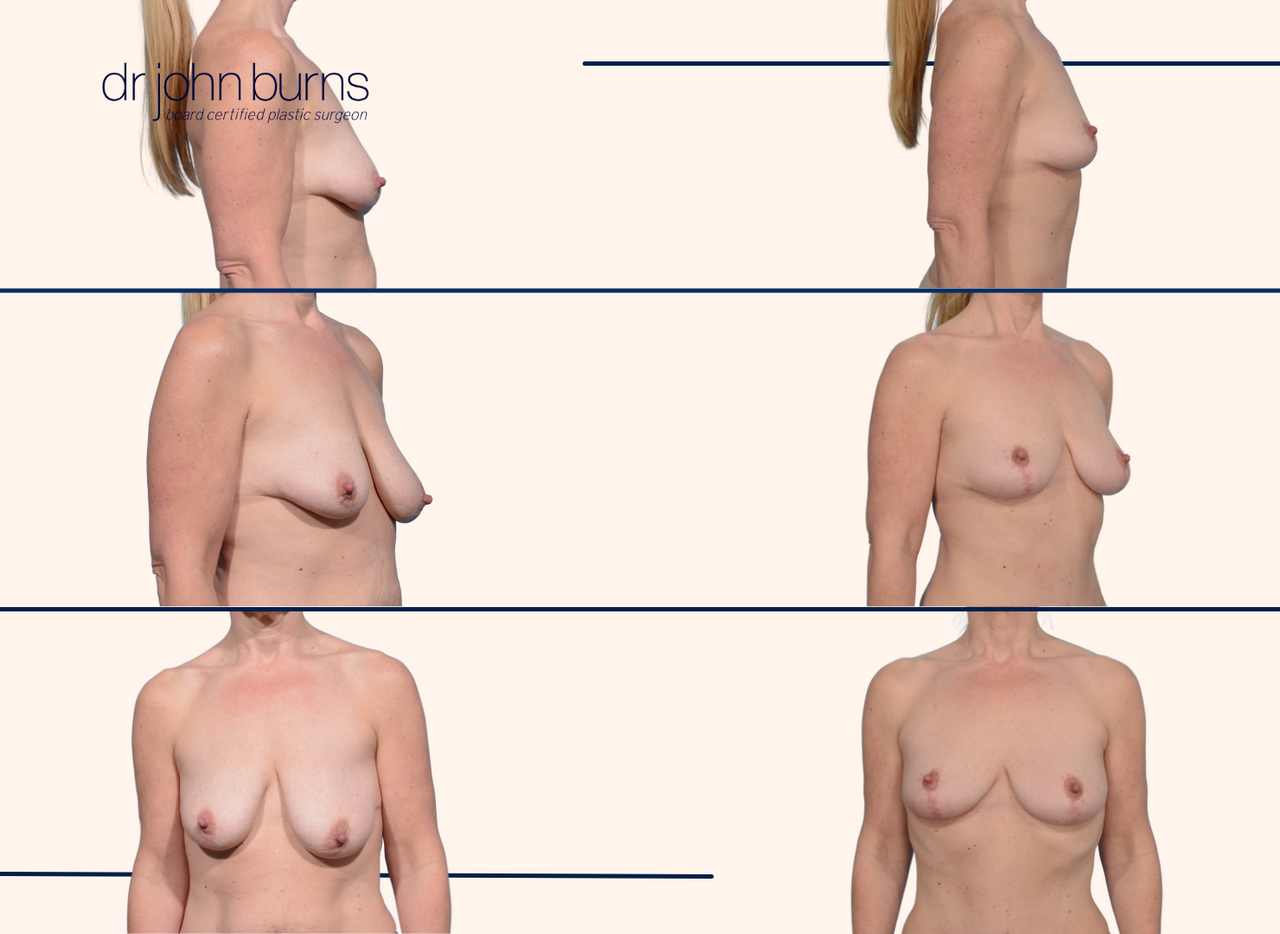 Before and After full breast lift by Dr. John Burns