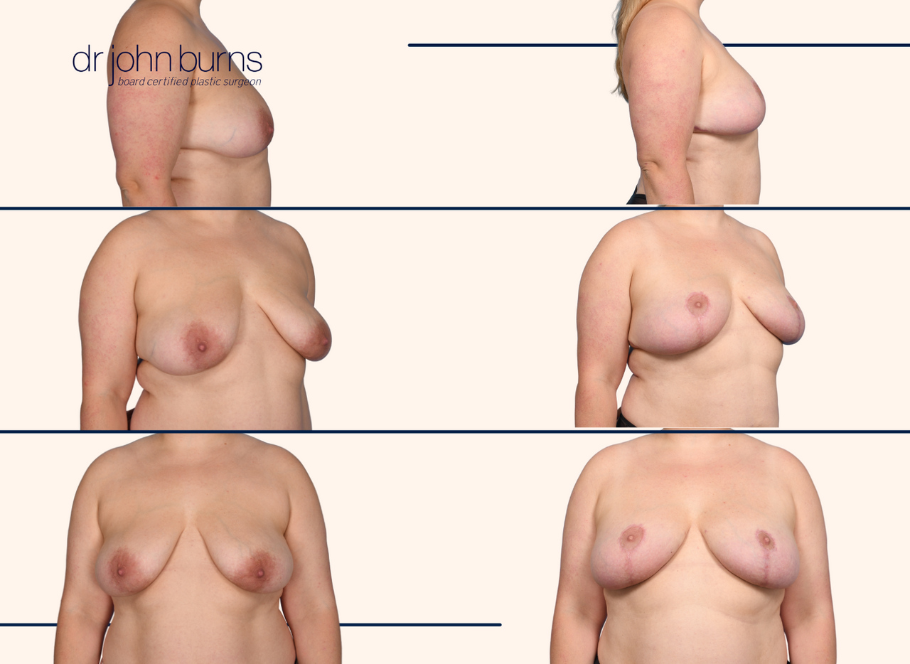 Before and after breast lift by Dr. John Burns