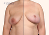 split screen comparison, before and after breast lift surgery