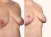 right 45 degree view | breast lift with areola resizing; up close view of scars