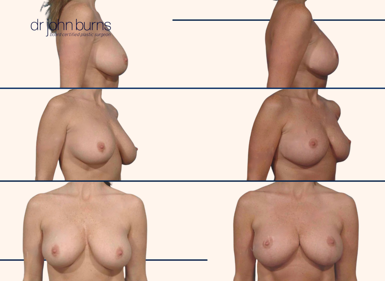 Breast lift before and after results by Dr. John Burns