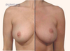 split screen view | before and after full breast lift surgery 