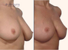 Right 45 degree view of before and after breast lift results 