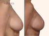 profile view | before and after breast lift surgery