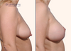 Case 3- Breast Lift