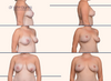 before and after full breast lift with anchor incision scars