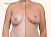 split screen | before and after breast lift results with close up of breast lift scars