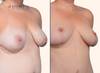 right 45 degree view of breast lift results