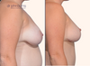 profile view | before and after full breast lift results