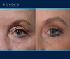 left eye view | before and after upper eyelid surgery