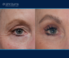 right eye view | before and after upper eyelid surgery