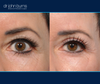 before and after left upper eyelid surgery