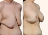 right 45 degree view | before and after breast lift with implant after massive weight loss
