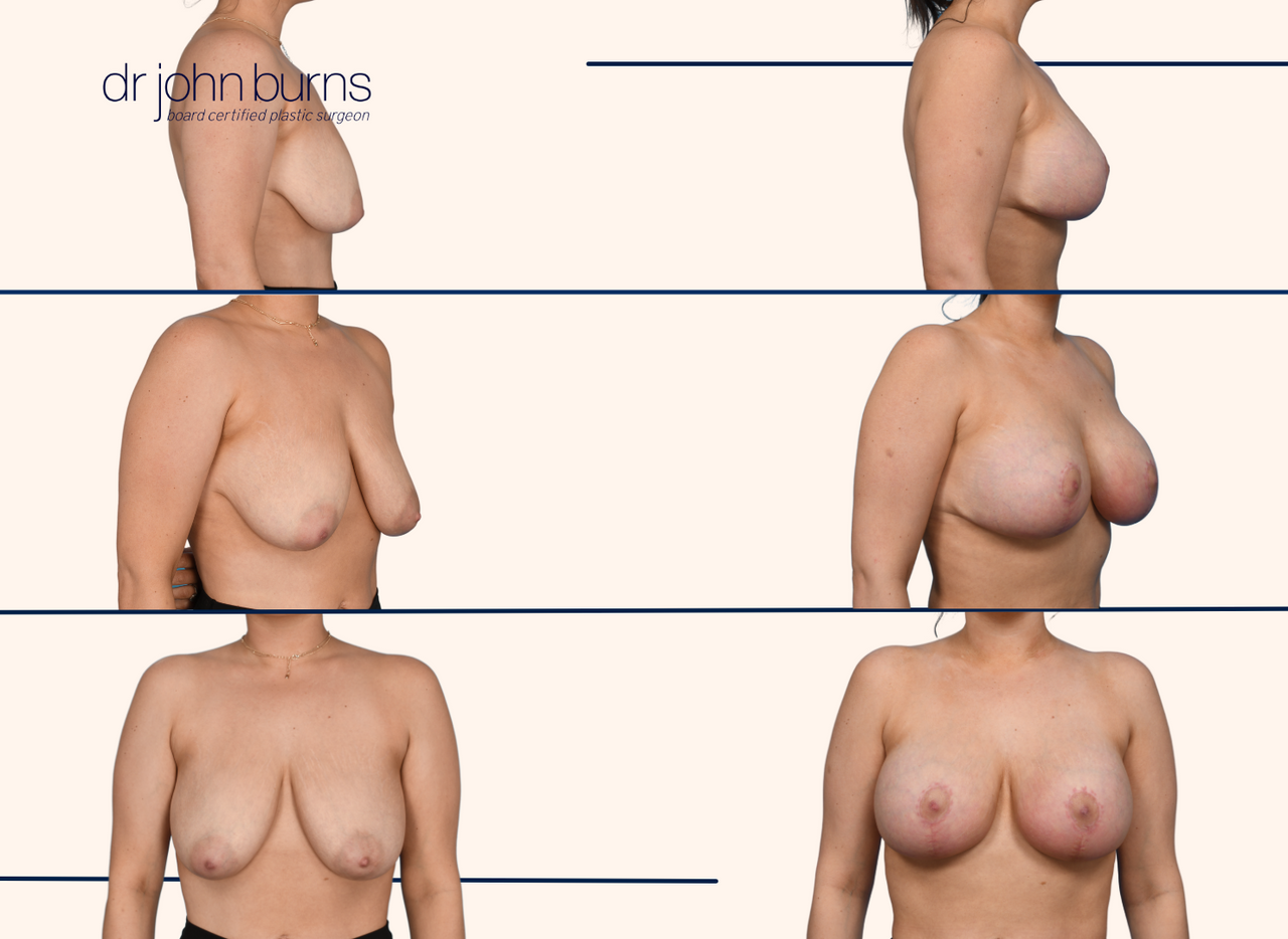 Before and after breast lift with implant results by Dr. John Burns