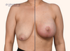 split screen | before and after breast lift with implants