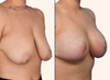 right 45 degree view | before and after breast lift with implant