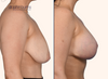 profile view | before and after breast lift with implant results