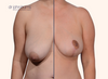 split screen | Before and after breast lift results by Dr. John Burns
