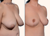 right 45 degree view | Before and after breast lift results by Dr. John Burns
