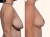 profile view | Before and after breast lift results by Dr. John Burns