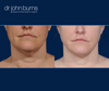 Before and After Neck Liposuction by Dr. John Burns