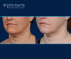 Before and After Neck Lift with Lipo by Dallas Plastic Surgeon, Dr. John Burns