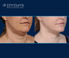 Before and AFter Dallas Neck Lift and Lipo by Dr. John Burns