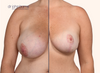 split screen | before and after breast lift