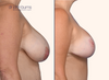 profile view | before and after breast lift by Dr. John Burns