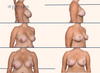 Before and after breast lift no implants by Dr. John Burns