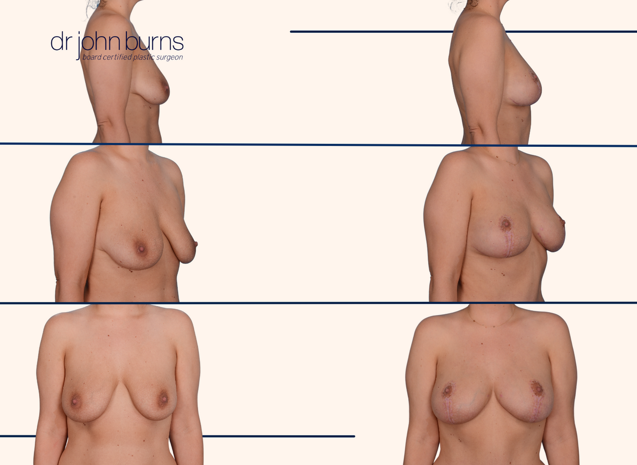 Before and after breast lift results by Dr. John Burns