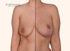 split screen | before and after breast lift surgery