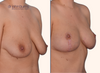 right 45 degree view | before and after breast lift results