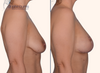 profile view | before and after breast lift results