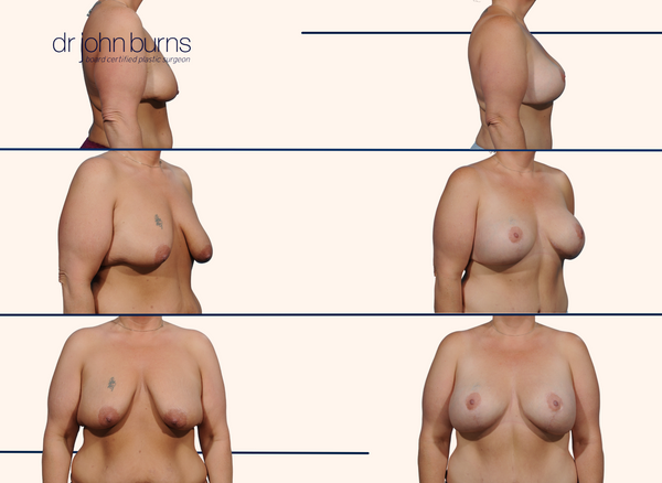 Before and after breast lift with breast lift scars