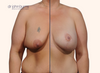 split screen | before and after breast lift 