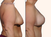 profile view | before and after breast lift results