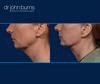 Left Profile VIew | Before and After Neck Lift with Lipo by Dallas Plastic Surgeon, Dr. John Burns