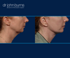 Right Profile View | Before and After Neck Lift with Lipo by Dallas Plastic Surgeon, Dr. John Burns