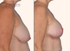 profile view | breast lift before and after results with breast lift scars by Dr. John Burns