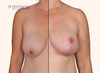 split screen breast lift results by Dr. John Burns