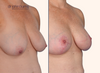 right 45 degree view | breast lift results with breast lift scars by Dr. John Burns