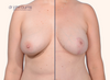 split screen | Before and after breast lift, breast asymmetry correction