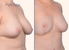 right 45 degree view | Before and after breast lift, breast asymmetry correction 