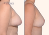 profile view | Before and after breast lift, breast asymmetry correction by Dr. John Burns