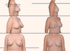 Before and after breast lift, breast asymmetry correction by Dr. John Burns