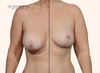 split screen | before and after breast lift photos by Dr. John Burns