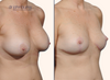 right 45 degree view | before and after breast lift photos by Dr. John Burns